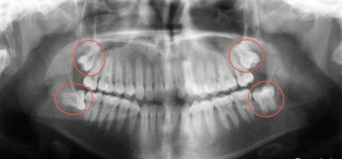 Лечат 8 зуб. Ретинированный зуб мудрости рентген. Ретинированный верхний зуб мудрости. Ретинированный третий моляр. Третий моляр верхней челюсти рентген.