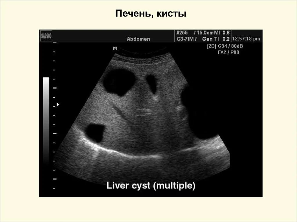 Поликистоз печени эхограмма. Поликистоз печени непаразитарная. Непаразитарные кисты печени УЗИ. Альвеококковая киста печени. Киста левой печени