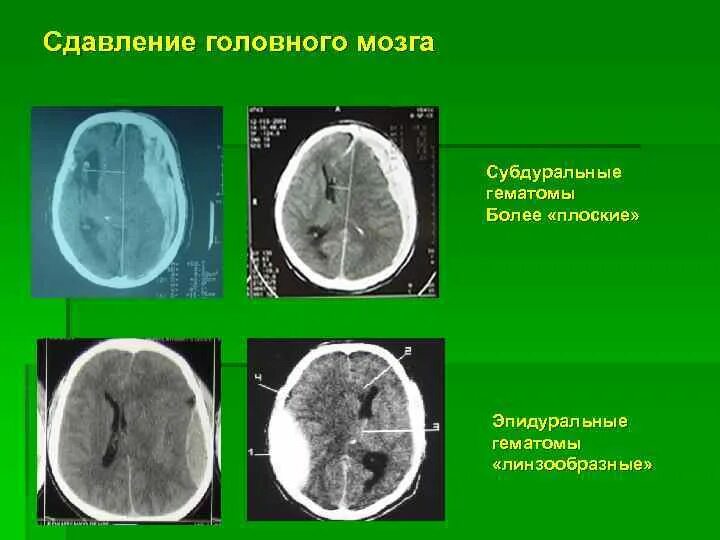 Субдуральная и эпидуральная гематома кт. Эпидуральная гематома на кт. Субдуральная гематома на кт. Гематома в головном мозге.