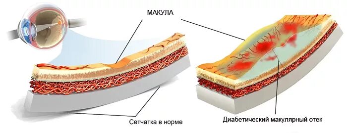 Диабетический макулярный отек глаза. Диабетический макулярный отек окт. Макулопатия макулярный отек. Кистовидный макулярный отек сетчатки.