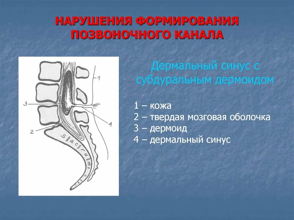 Аномалии развития позвоночника. Нарушение формирования позвонков. Стенозирование позвоночного канала. Относительный Сагиттальный стеноз позвоночного канала. Крестцовый стеноз