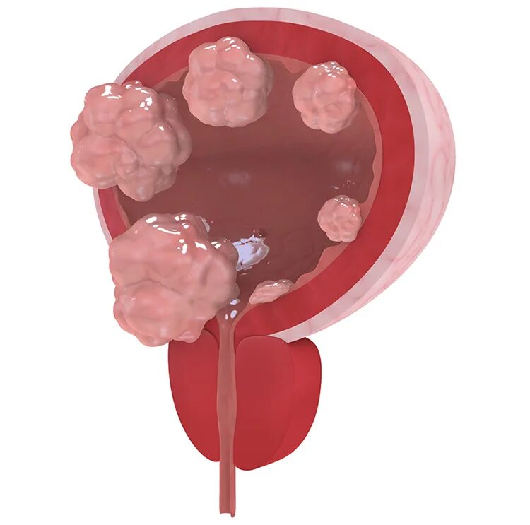 Рак мочевого химиотерапия. Опухоль мочевого пузыря. Опухоли мочевогоп пузыря. Маркеры опухоли мочевого пузыря. Опухоль на ножке в мочевом пузыре.