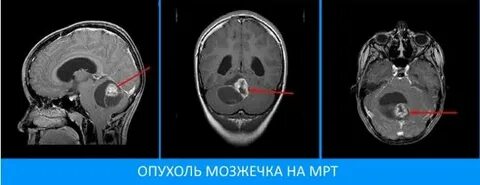 Опухоль мозжечка