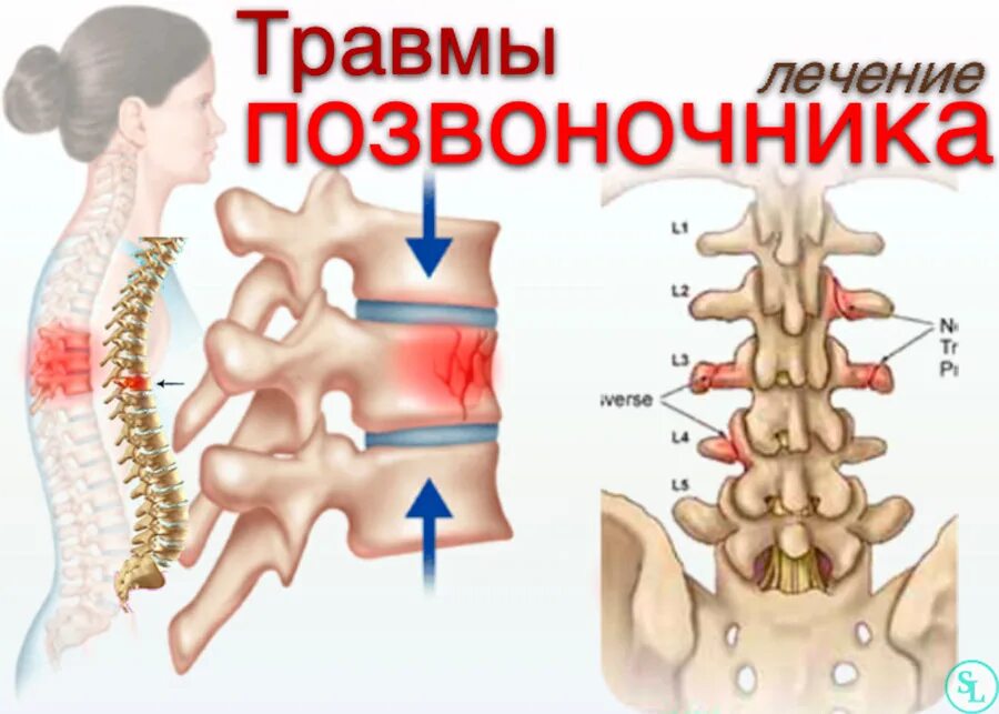 Травма позвоночника, спины. Травмы грудного и поясничного отделов позвоночника. Повреждения позвоночника столбы.