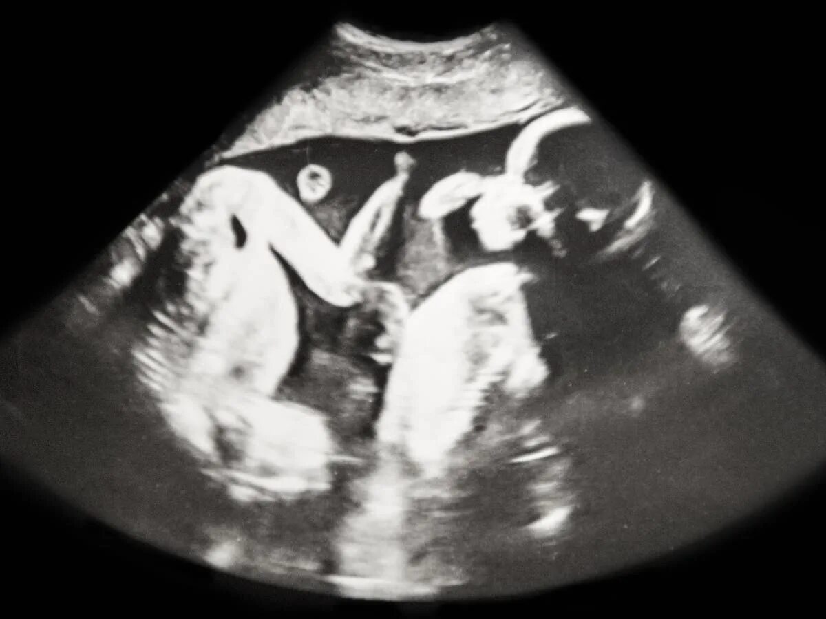 Двойня 25 недель. Фото УЗИ двойняшек близнецов и одного.