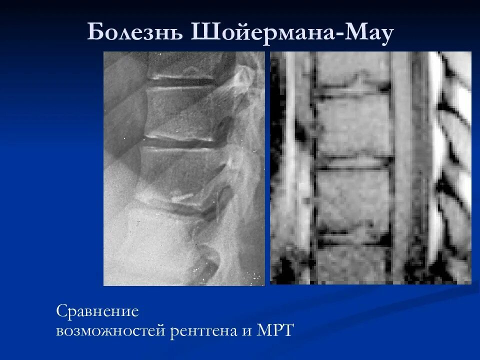 Болезнь шойерман мау что это такое. Болезнь шейермана мау мрт. болезнь шейермана-мау мрт позвоночника. б-нь шойермана-мау рентген. шермана мау позвоночника мрт.