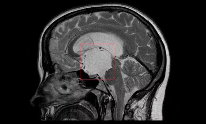 киста кармана ратке мрт снимок. киста гипофиза головного. киста головного мозга кармана ратке гипофиза. киста ратке гипофиза на мрт. кт анатомия гипофиза.