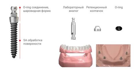 Имплантат для съемного протезирования