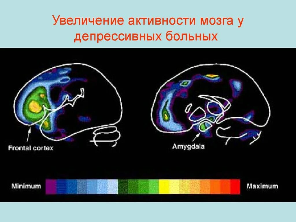 Активность мозга. Мозг депрессивного больного. Активность мозга при депрессии. Повышение активности мозга