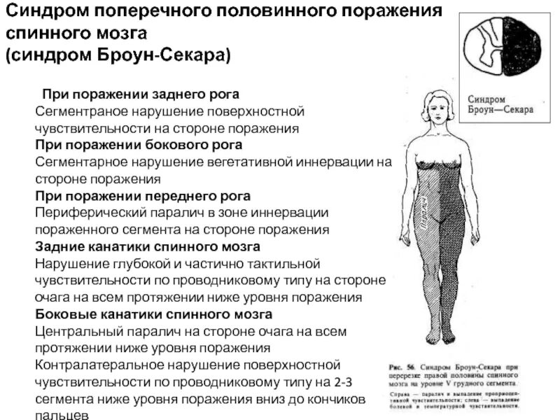 Синдром полного поперечного поражения. Сегментарный диссоциированный тип расстройства чувствительности. Синдромы поражения чувствительности. Синдром броун-секара методы исследования. Синдром поражения боковых канатиков.