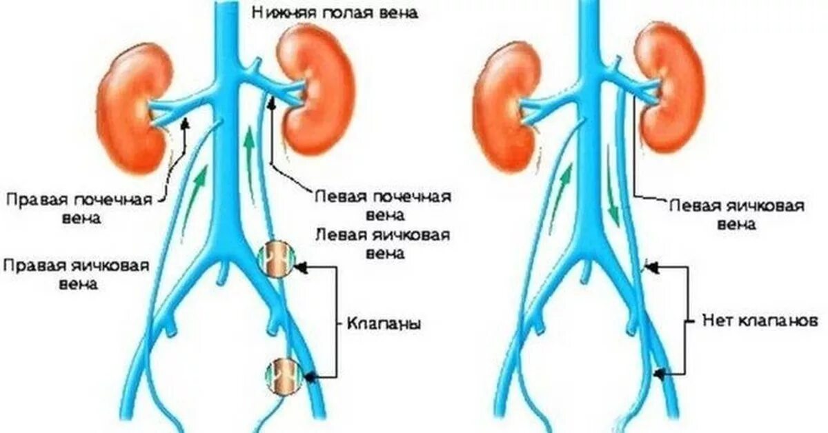 Болит яичко у мужчины. Варикоцеле у детей клинические рекомендации. Причины первичного варикоцеле:.