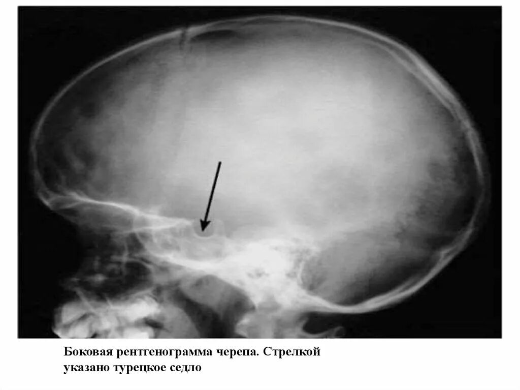 Образование турецкого седла. Рентген турецкого седла опухоль гипофиза. Турецкое седло рентген. Турецкое седло на ТРГ. Рентген черепа турецкое седло.