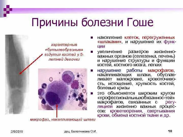 Болезнь гоше клинические проявления. Генетическая болезнь гоше. Болезнь гоше клинические проявления. Болезнь гоше патогенез. Болезнь гоше клинические рекомендации.