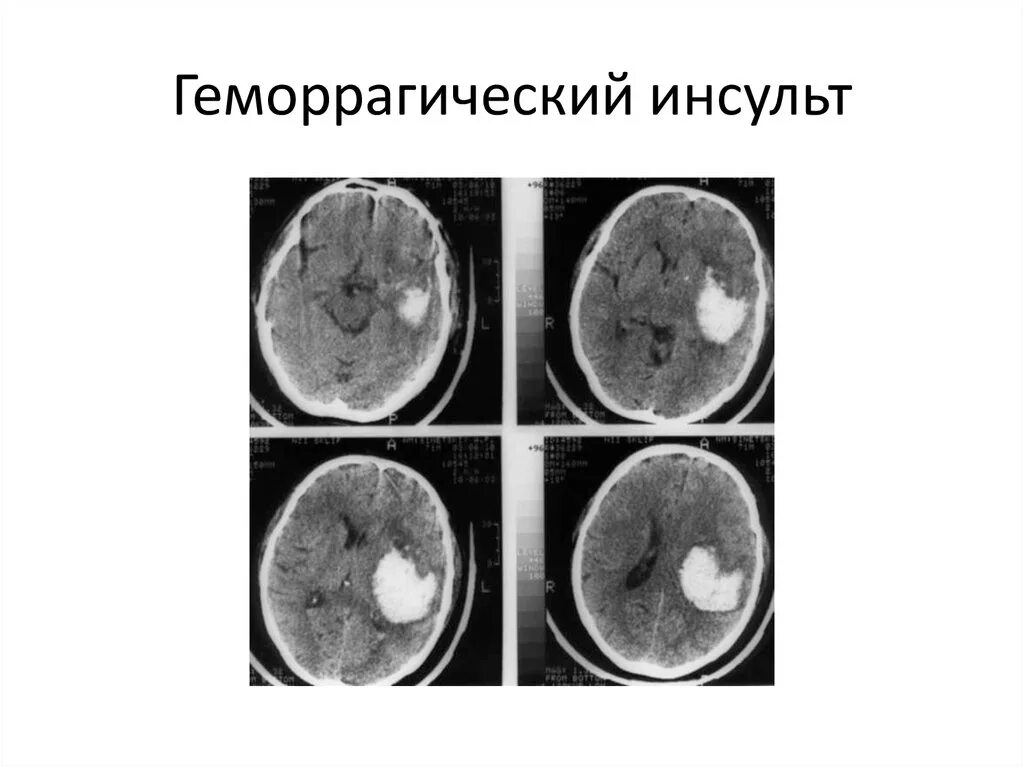 Был геморрагический инсульт. Геморрагический инсульт микроскопия. Геморрагический инсульт параноидальный. Геморрагический инсульт головного мозга кт. Геморрагический вентрикулярный инсульт клиника.