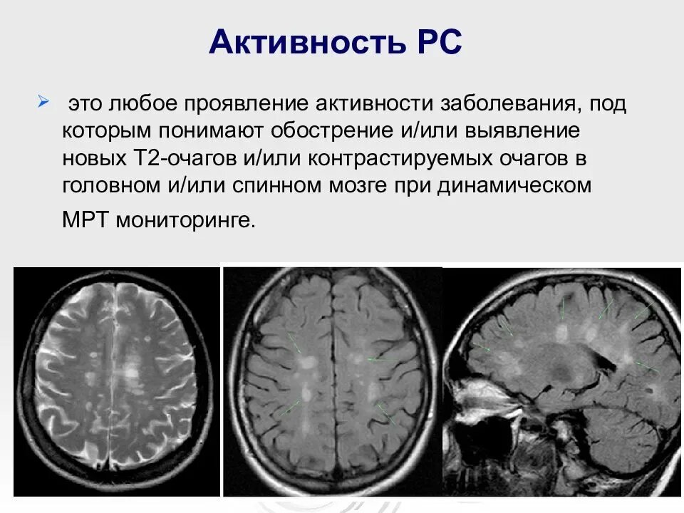 Очаг ограничения диффузии. Рассеянный склероз демиелинизация. демиелинизация спинного мозга мрт. рассеянный склероз очаги поражения.
