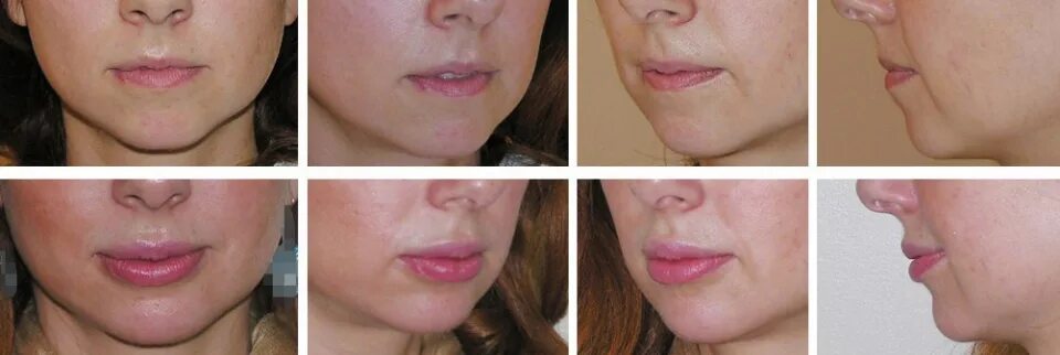 Губы с 1 мл гиалуроновой кислоты до после. Липофилинг губ до и после. Липофилинг губ до и после. Губы после липофилинга. Липофилинг губ после травмы.
