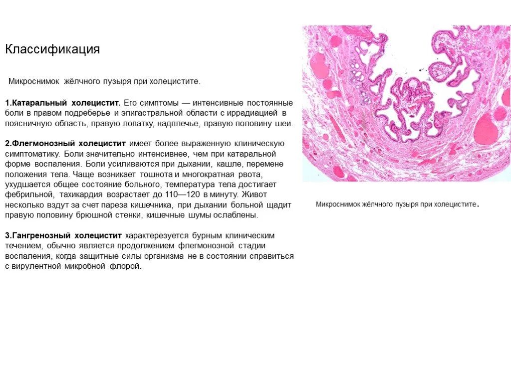 Острый холецистит патанатомия гистология. Хронический калькулезный холецистит препарат патанатомия. Хронический калькулезный холецистит гистология. Холецистит микропрепарат описание.