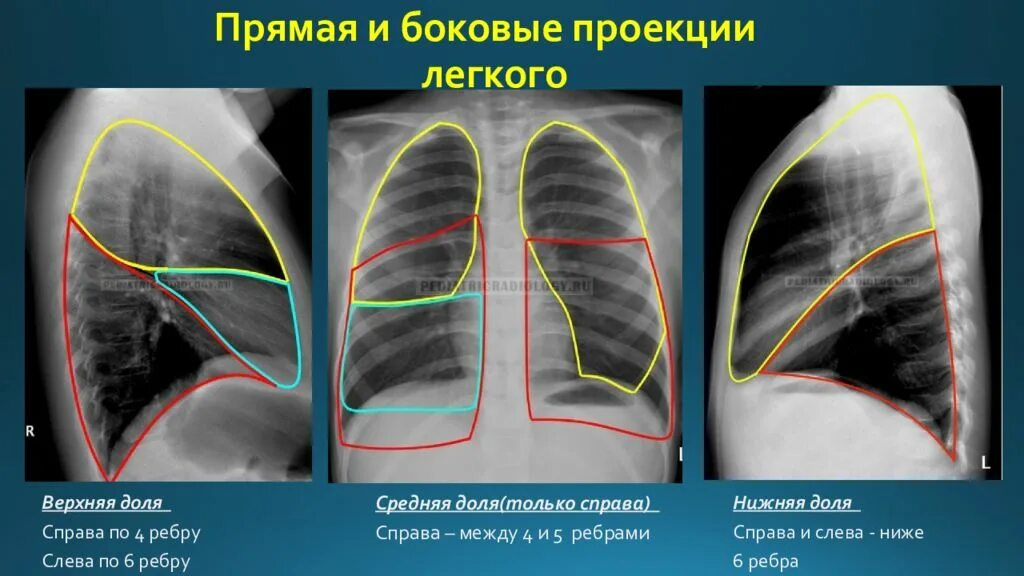 Доли легкого на рентгенограмме. Легкие в прямой проекции схема рентген. Легочные доли на рентгене легких. Доли легкого на рентгенограмме в боковой проекции.