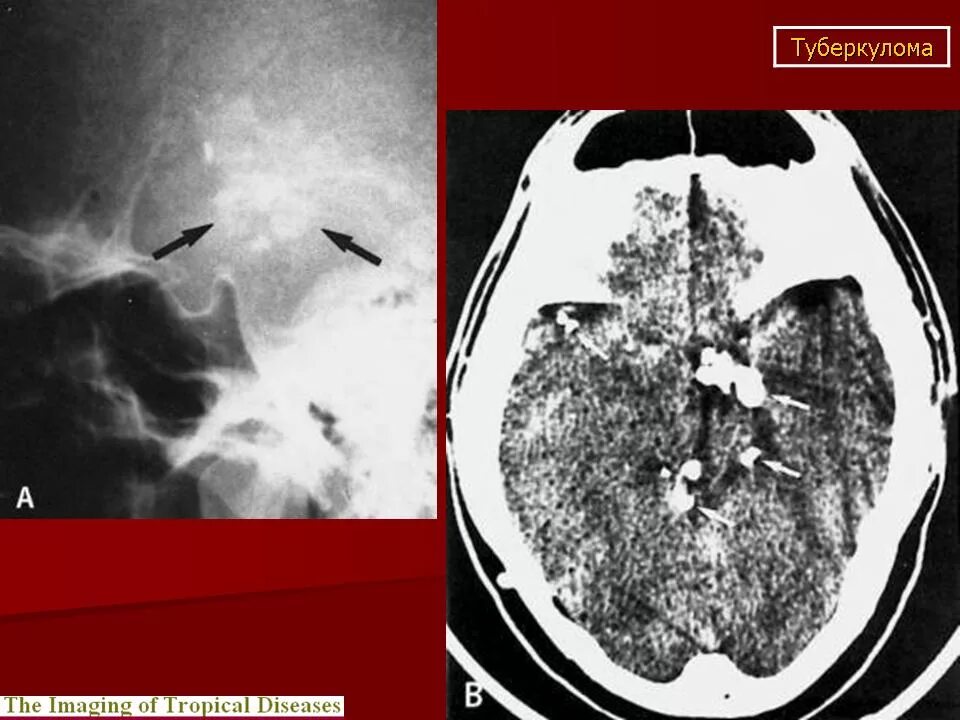 Туберкулез головного. Туберкулема головного мозга мрт. Туберкулема головного мозга на кт. Туберкулома головного мозга кт. Туберкулез головного мозга кт.