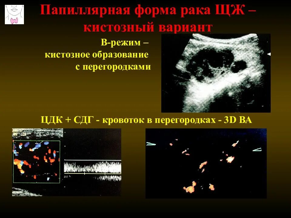 Папиллярная карцинома. Папиллярная карцинома щитовидной железы типы. Папиллярная карцинома на УЗИ щитовидной. Папиллярный рак после операции