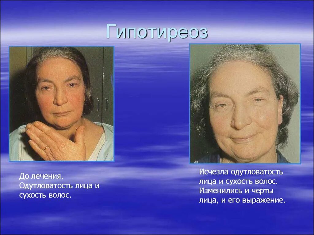 схема лечения гипотиреоза. гипотиреоз у детей эпидемиология. гипотиреоз памятка. гипотиреоз у детей классификация. гипотиреоз симптомы у женщин.