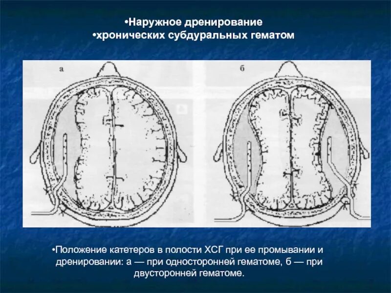 Субдуральная гематома Трепанация черепа. Закрытое наружное дренирование субдуральной гематомы. Наружное дренирование хронической субдуральной гематомы. Дренирование хронической субдуральной гематомы. Субдуральная гематома лечение