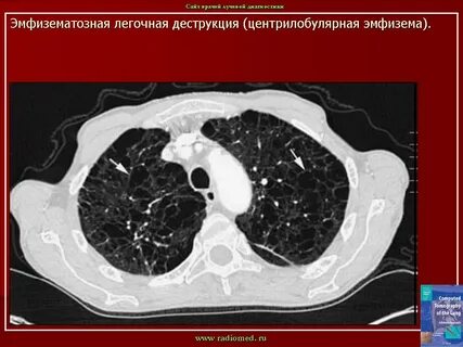 Парасептальная эмфизема на кт