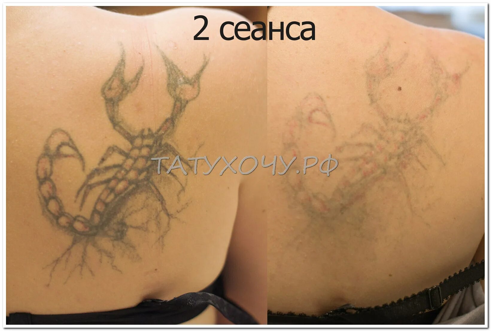татуировки после сведения. удаление тату тула. сведение тату до и после. результаты сведения тату лазером. удаление тату до и после.
