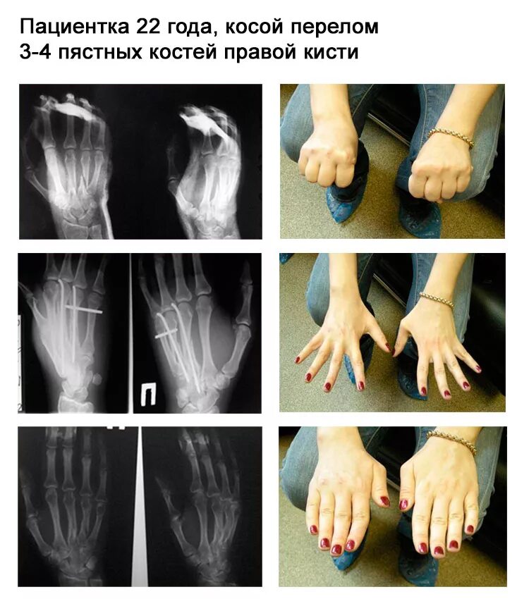 Спицы при переломе кисти. Остеосинтез пятой пястной кости. оскольчатый перелом пястной кости. остеосинтез пятой пястной кости кисти. мкб перелом пястных костей кисти.