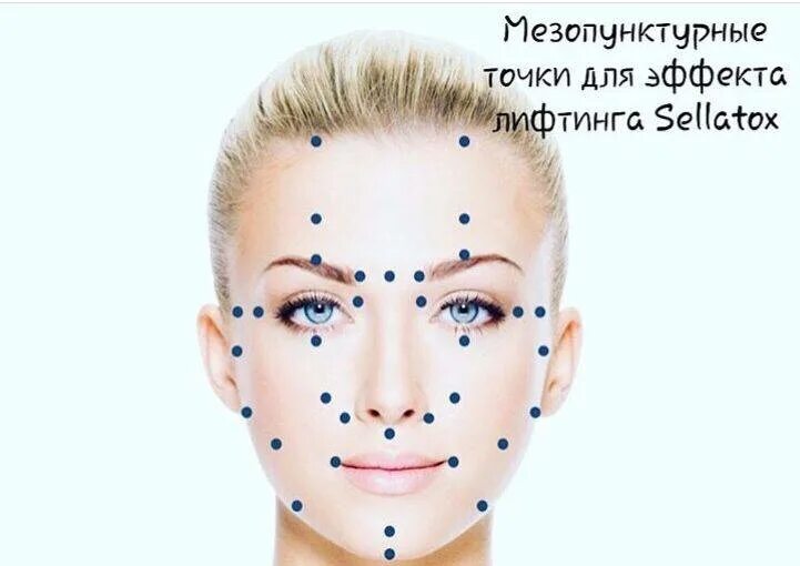 Схема мезотерапии ДМАЕ. Мезотерапия ДМАЕ схема. Схема мезотерапии лица с ДМАЕ. Техника ДМАЕ точки.