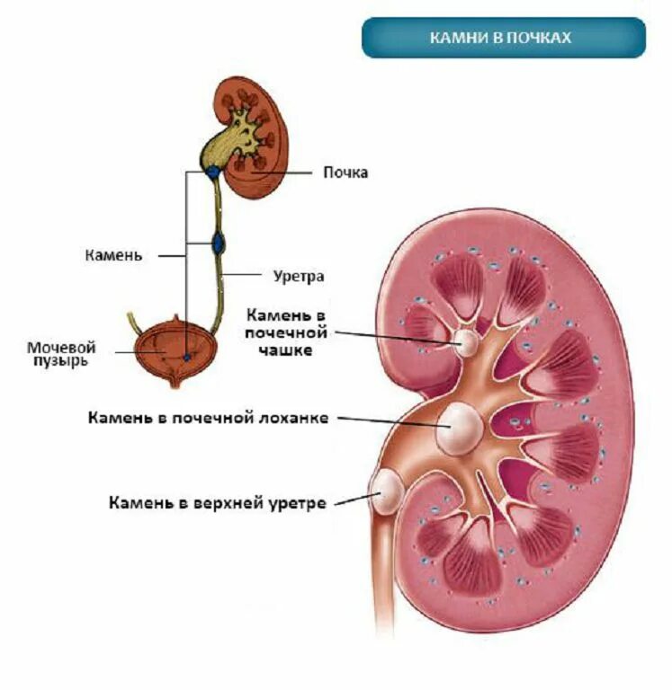Мочекаменная болезнь расположение камней. Конкремент лоханки почки. Строение почки камни в почках.