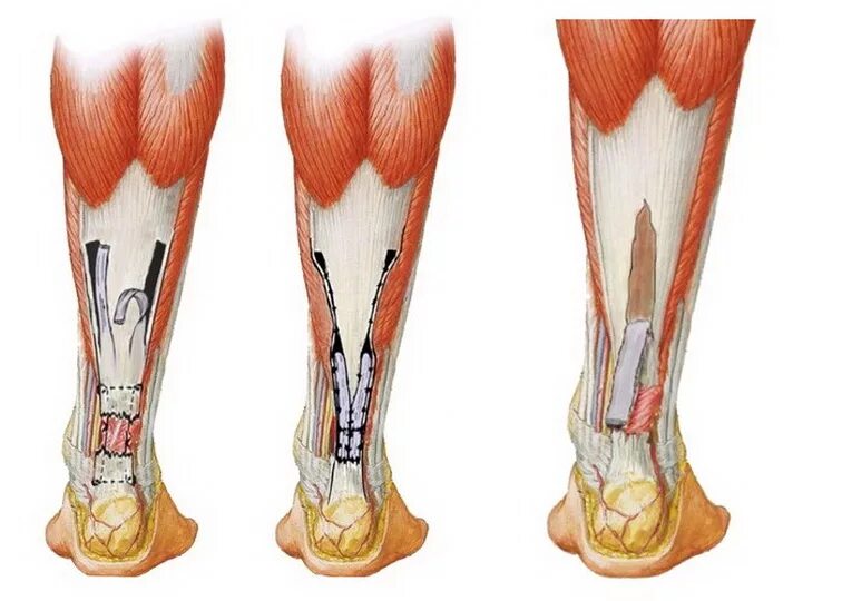 Разрыв ахиллова сухожилия. Надрыв ахиллова сухожилия. Анатомия ахилового сухожилия. Тендинит пяточного ахиллова сухожилия. Ахиллово сухожилие разрыв ахиллова сухожилия