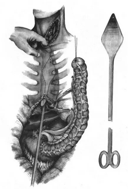 Искусственный пищевод. Операция Торека Герцена. Эзофагопластика толстой кишкой. - Пластика пищевода кишечным трансплантатом.. Тонкокишечная пластика пищевода.