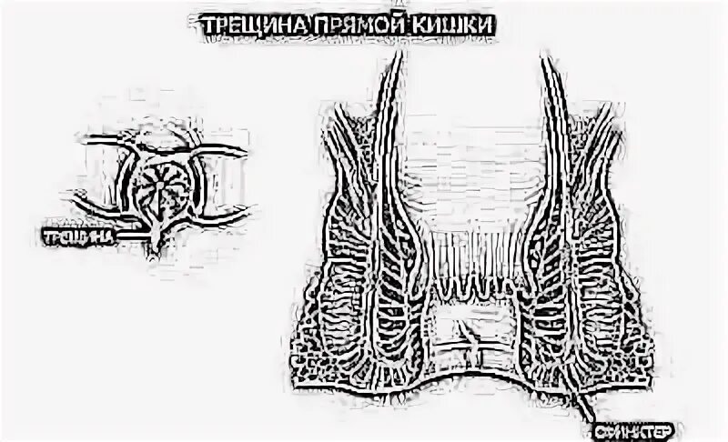 Трещина заднего прохода как лечить у женщин. Трещина в заднем проходе фото. Анальная трещина у новорожденного. Трещина заднего прохода свитера. Как выглядит анальная трещина у грудничка.