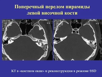 Перелом височной кости