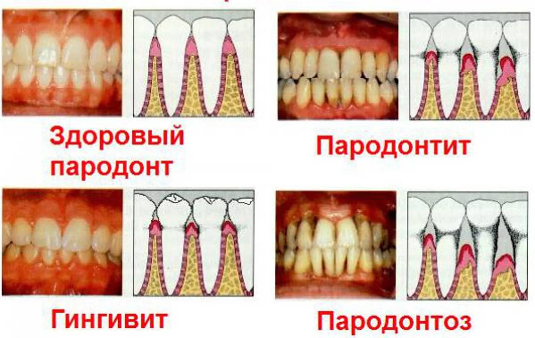 Чувствительность зубов после лечения. Быстропрогрессирующий пародонтит. Некротизирующий гингивит. Гингивит пародонтит периодонтит. Стоматический гингивит.