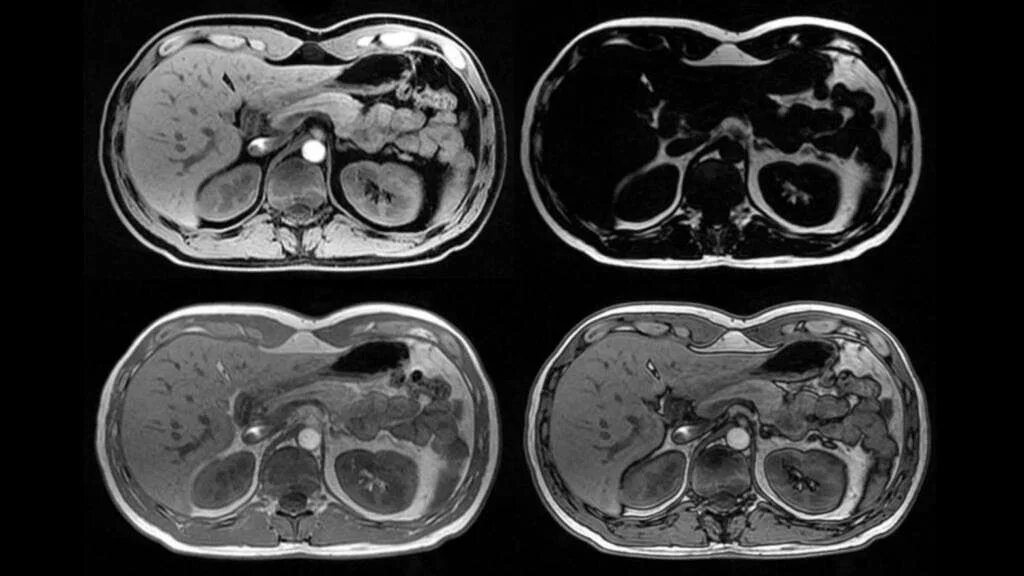 Мрт снимки брюшной полости патология. Магниторезонансная томография ЖКТ. Магнито-резонансная томография желудка. Кровь после кт