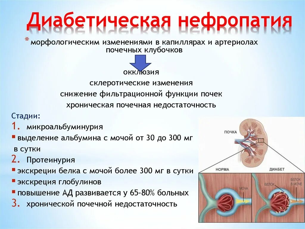 Почему в почках белок. Диабетическая нефропатия (патология почек);. Сахарный диабет 2 типа диабетическая нефропатия. Диабетическая нефропатия почечная недостаточность. Нефропатия при сахарном диабете симптомы.