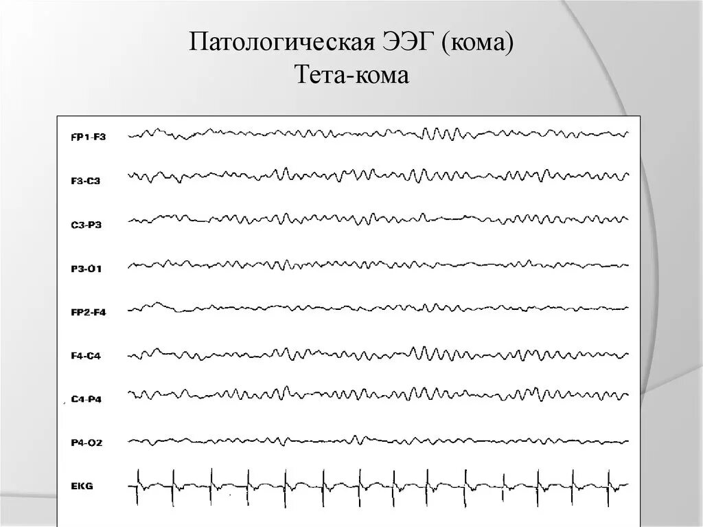 Дельта кома на ЭЭГ. Бета кома на ЭЭГ. Альфа кома на ЭЭГ. Патологические ритмы ЭЭГ.