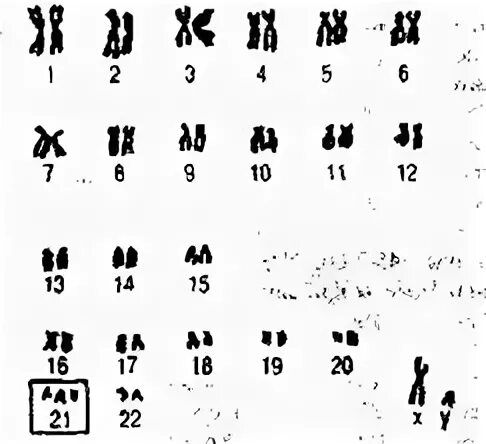 Идиограмма синдрома Дауна. Идиограмма 21 хромосомы. Идиограмма дождя. Количественные аномалии аутосом.
