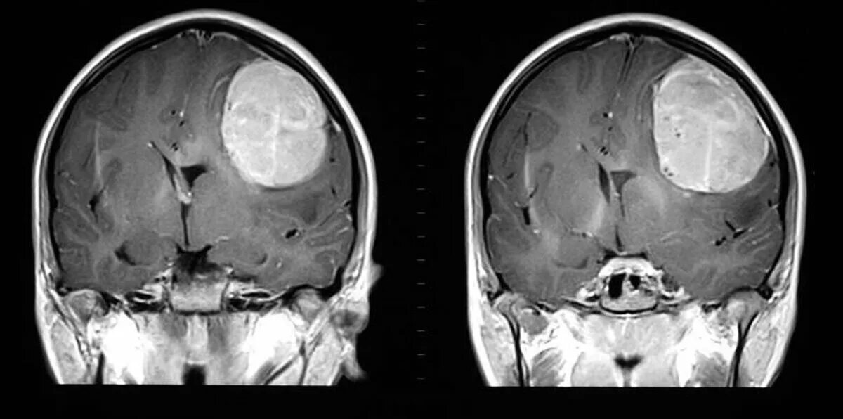 Глиобластома головного мозга на кт и мрт. Глиобластома височно теменной области. Как выглядит опухоль головного мозга. Злокачественное новообразование мозга
