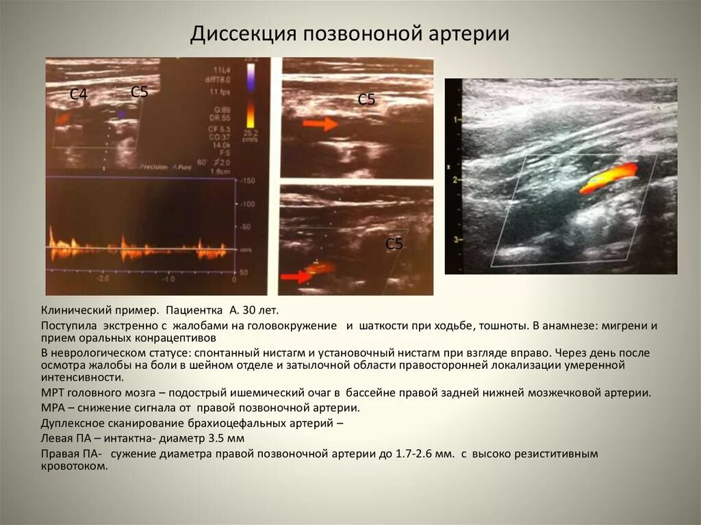 Диссекция вса. Диссекция внутренней сонной артерии на узи. диссекция внутренней сонной артерии кт. диссекция церебральных артерий. диссекция позвоночной артерии на узи.