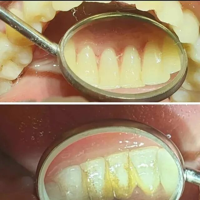Чистка зубов в нижнем. Пришеечный зубной камень. Пародонтит зубной камень. Неминерализованные зубные отложения. Поддесневой зубной камень.