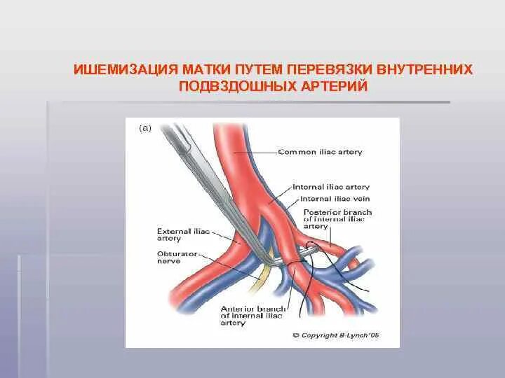 Если месячные если перевязать трубы. Перевязка подвздошных артерий. Перевязка внутренней подвздошной артерии. Эмболизация внутренних подвздошных артерий. Перевязка внутренних подвздошных артерий Акушерство.