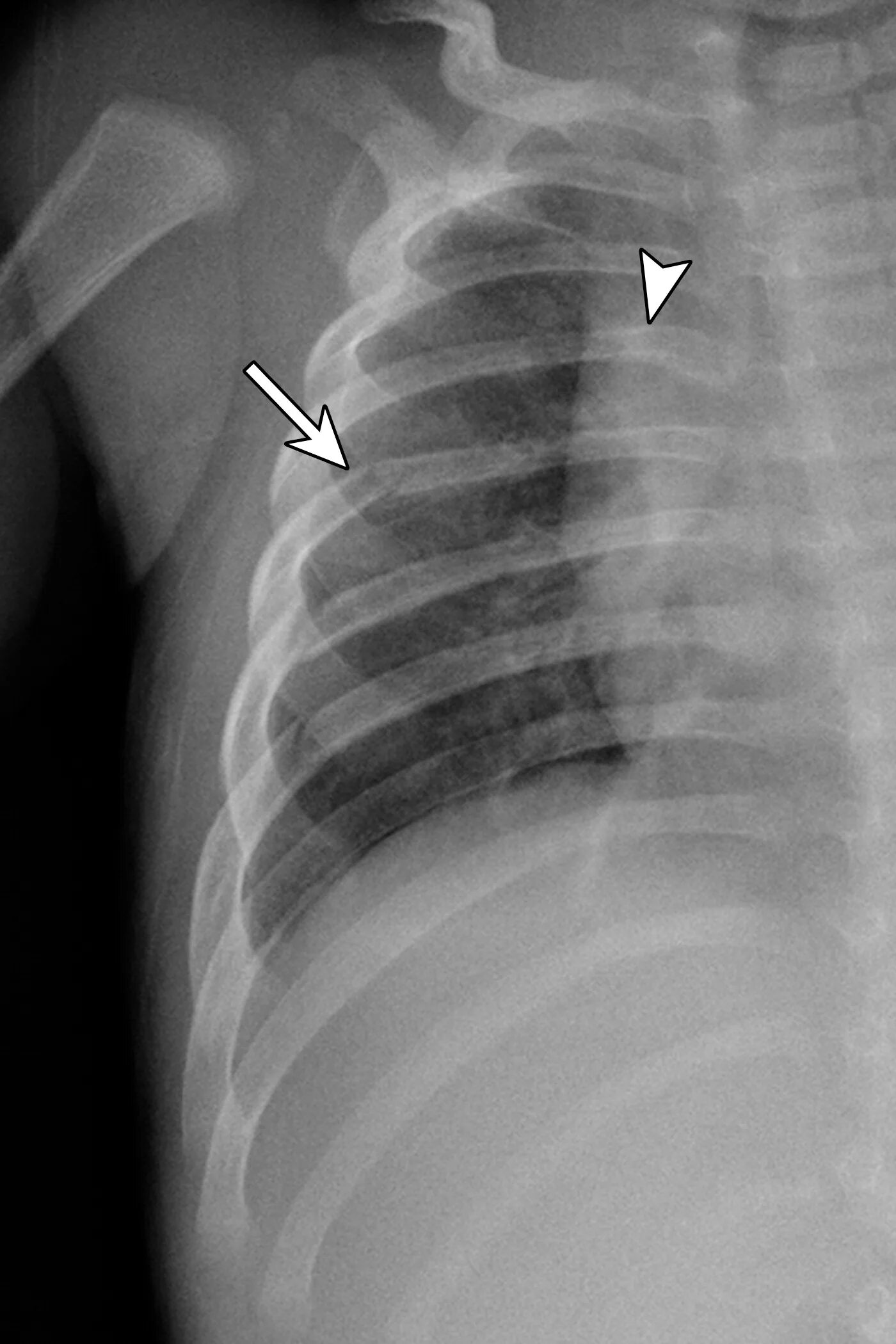 Трещины на грудном. Перелом грудной клетки рентген. Рентген перелом ребра слева. Перелом ребер рентгенограмма. Перелом грудины рентген.