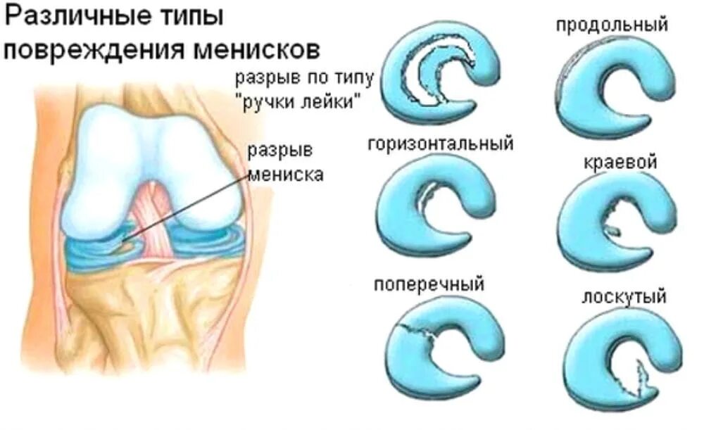 Разрывы менисков коленного сустава классификация. Разрыв заднего рога медиального мениска Stoller 2. Что такое лоскутный разрыв мениска коленного сустава.