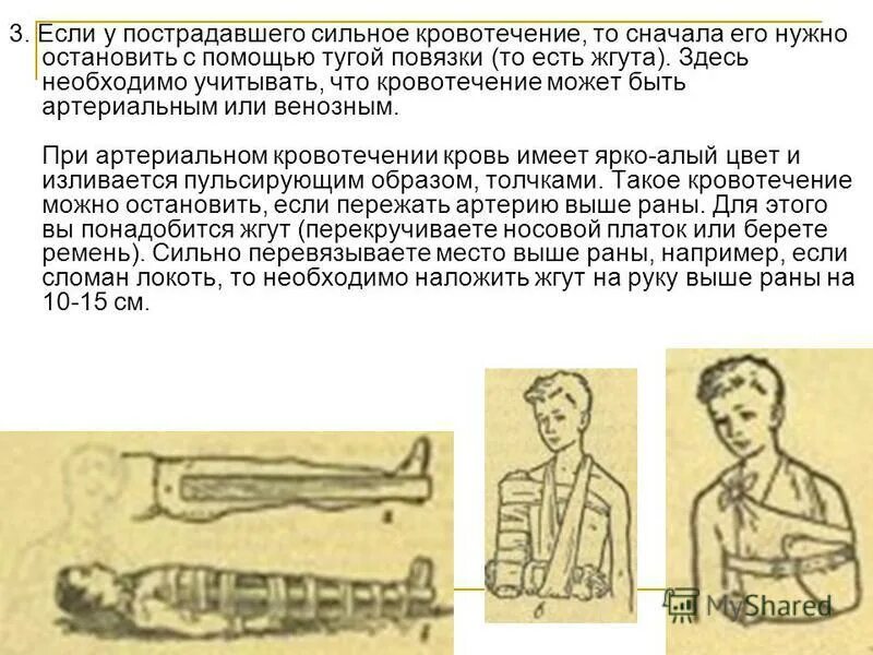 Виды переломов и первая помощь при них. Кровотечение при переломе. Оказание первой помощи при переломах. Остановка кровотечения.. Жгут при открытом переломе.