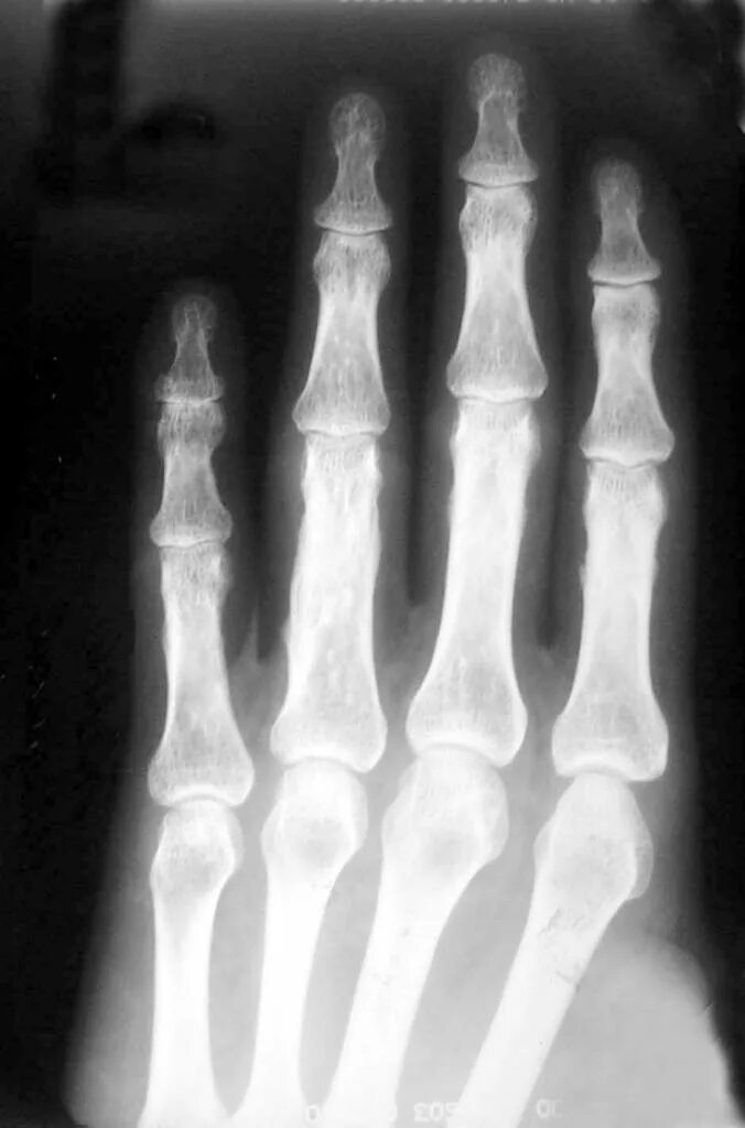 Открытый перелом фаланги. Оскольчатый перелом основной фаланги 1 пальца. Перелом головки основной фаланги 1 пальца стопы рентген. Перелом средней фаланги 1 пальца стопы. Подголовчатый перелом основной фаланги 1 пальца кисти.