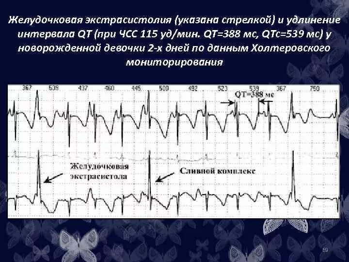 Сколько экстрасистол норма