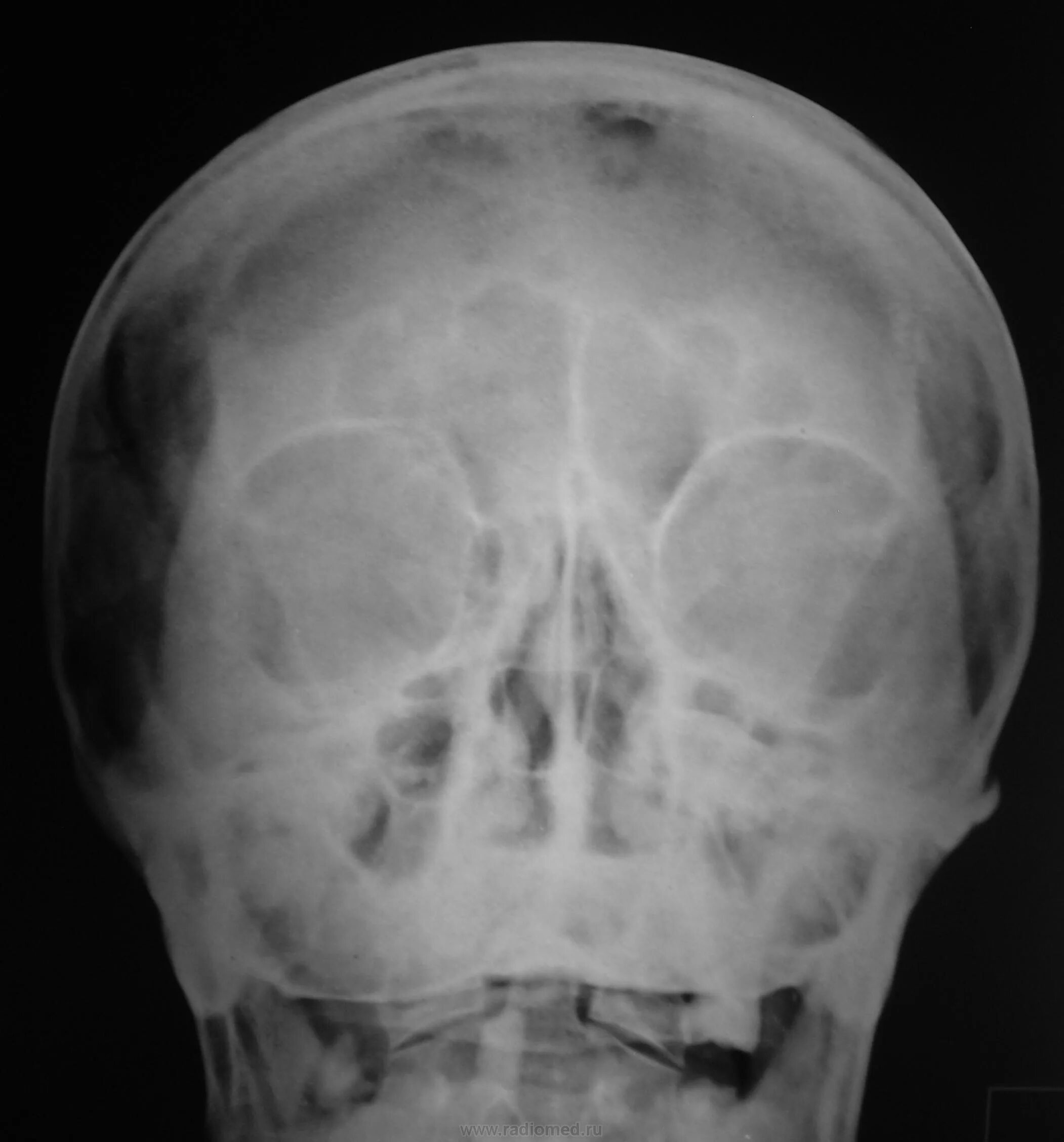 Кости черепа рентген. Остеома лобной рентген. Остеома костей черепа рентген. Фиброзная дисплазия черепа рентген.